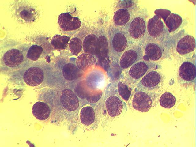 adenokarcinoma-mzh Цитологическое исследование