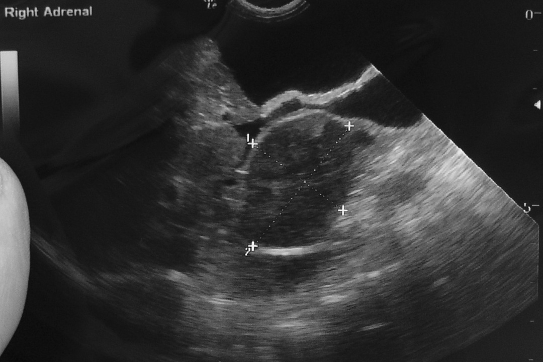 right-adrenal-U-S УЗ-исследование надпочечников