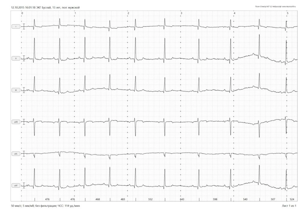 elektrokardiogramma-ekg Электрокардиография (ЭКГ)